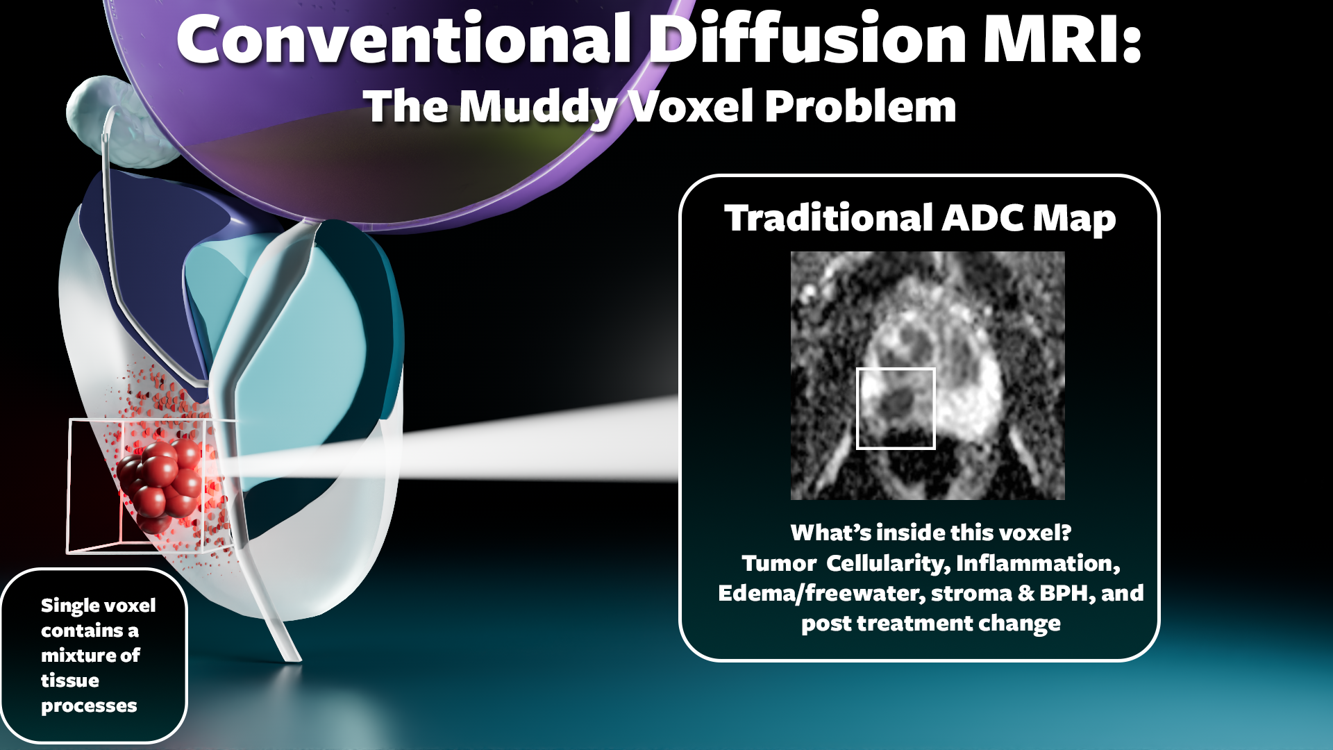 Illustration showing how conventional diffusion MRI averages tumor, inflammation, stroma, and glandular fluid into a single mixed voxel ADC value, losing detail about individual tissue components