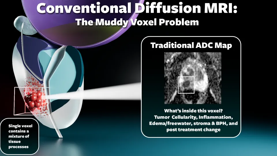 Illustration showing how conventional diffusion MRI averages tumor, inflammation, stroma, and glandular fluid into a single mixed voxel ADC value, losing detail about individual tissue components
