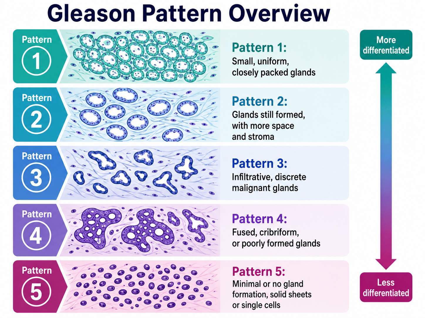 Gleason pattern overview showing progressively less differentiated prostate cancer gland architecture