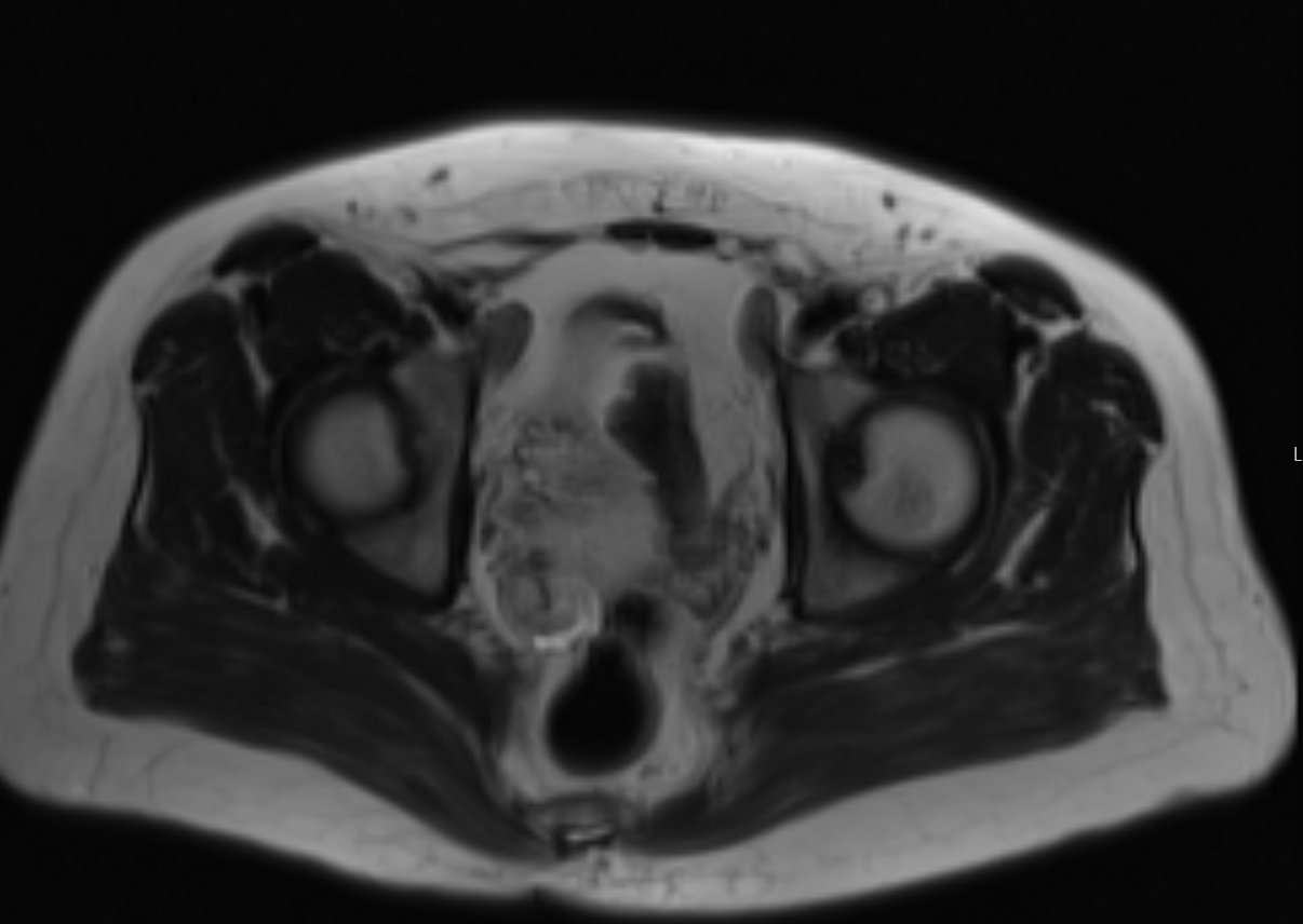 Axial pelvic MRI with a suspicious lymph node highlighted near the inguinal ligament, along the distal external iliac chain