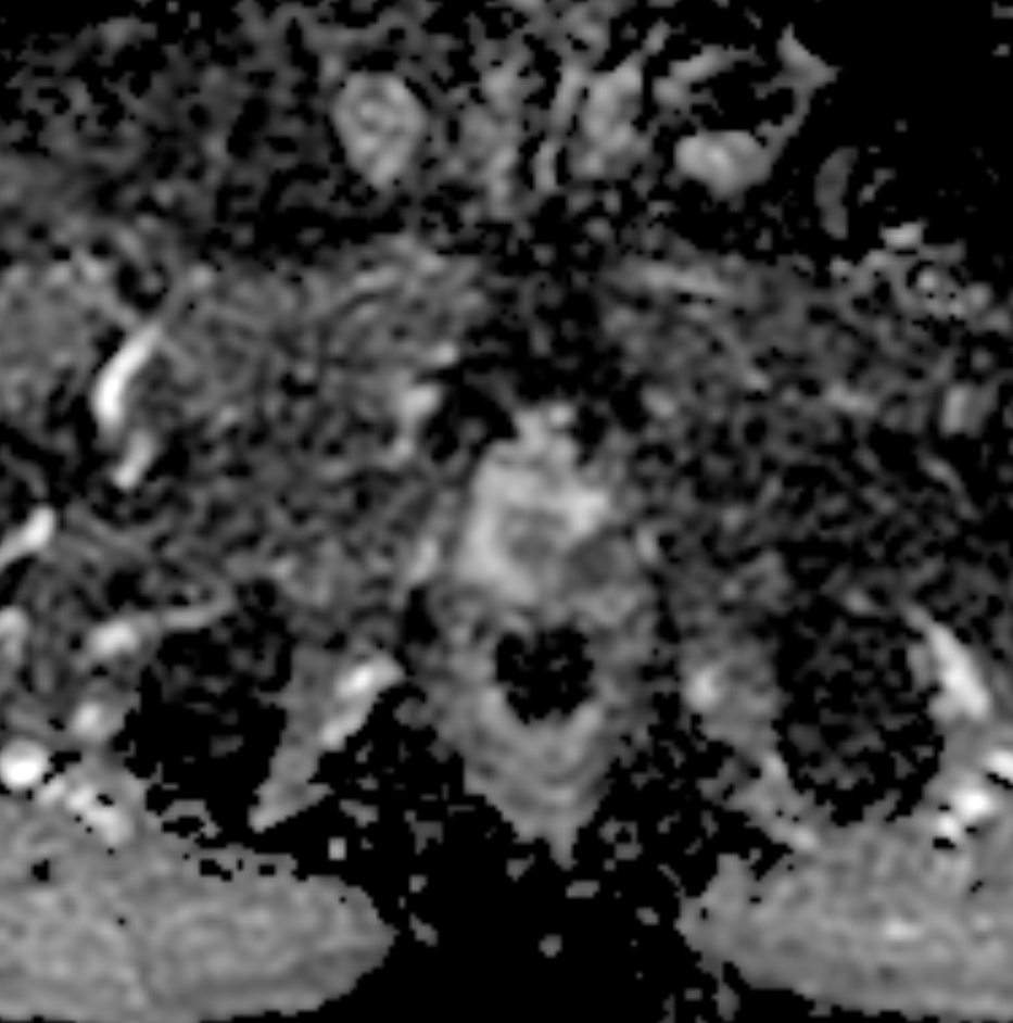 ADC map showing marked focal hypointensity in a peripheral-zone lesion