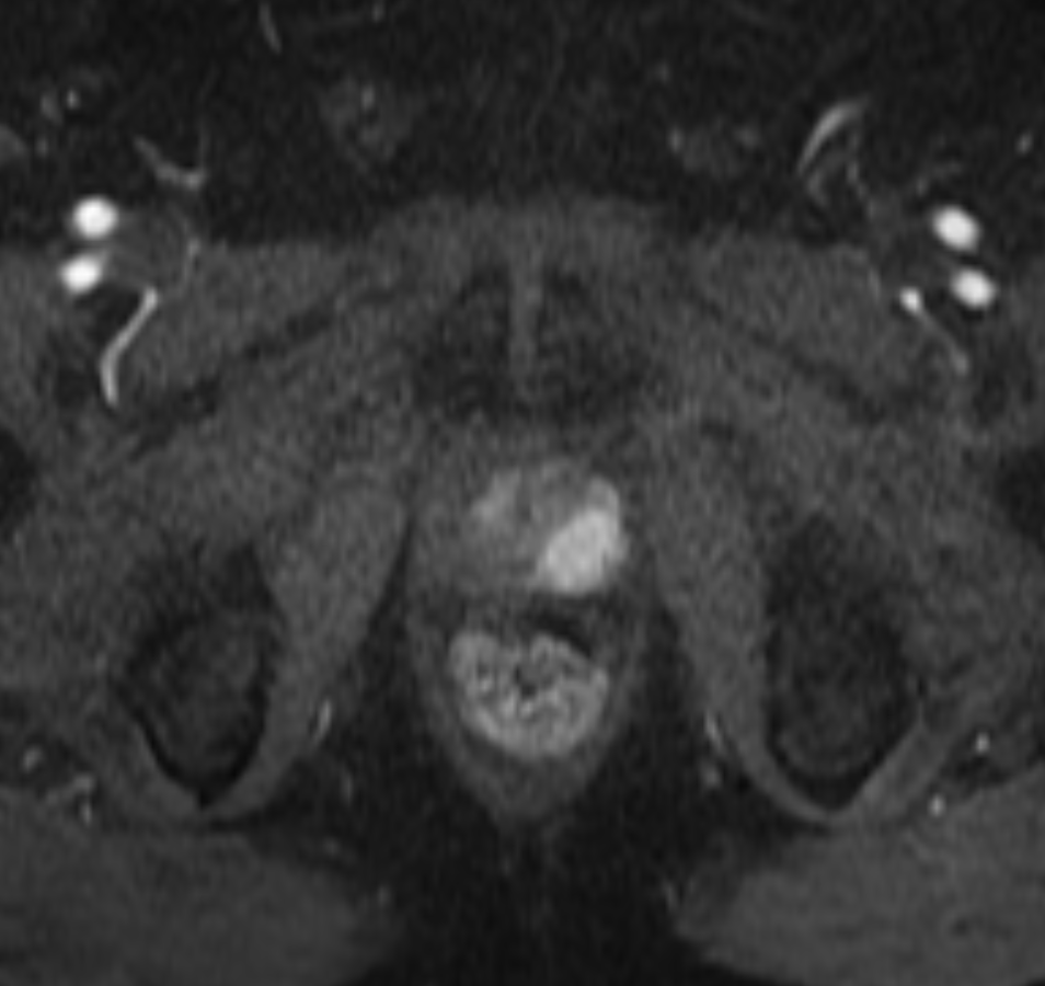 Early arterial subtraction DCE showing focal early enhancement in a peripheral-zone lesion