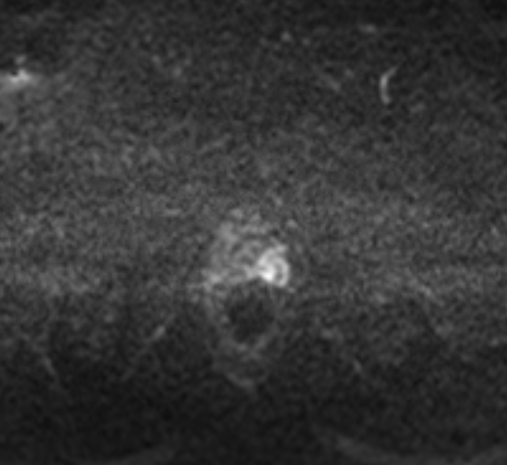High b-value DWI showing marked focal high signal in a peripheral-zone lesion