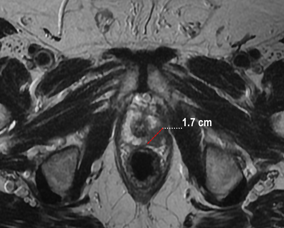 Axial T2-weighted MRI showing a peripheral-zone prostate lesion