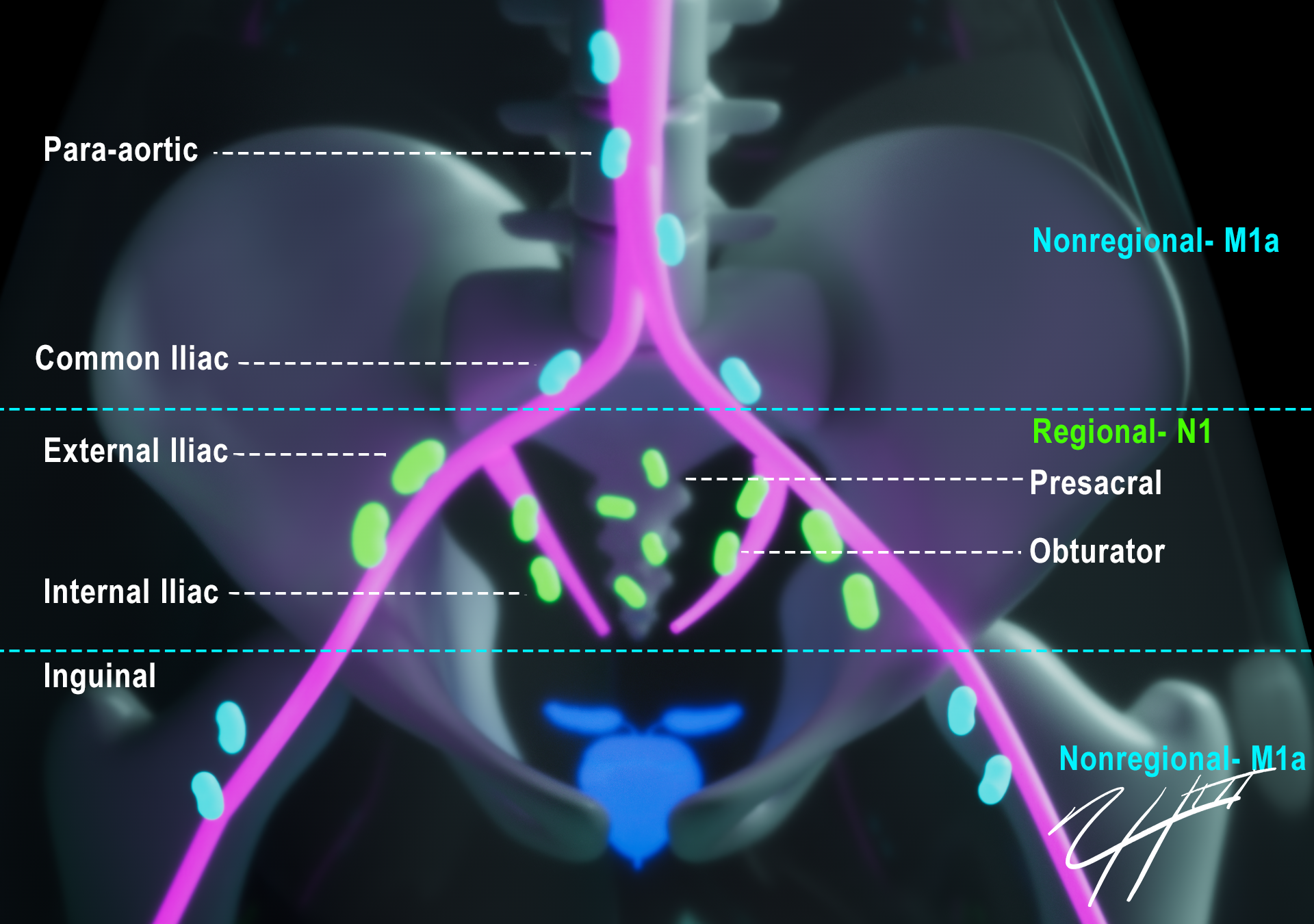 Labeled frontal illustration of the pelvic and lower abdominal lymph node stations relevant to prostate cancer staging