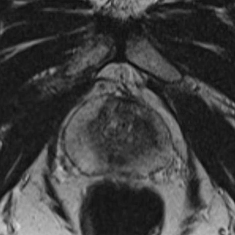 Axial T2-weighted MRI at the level of the periprostatic anatomy