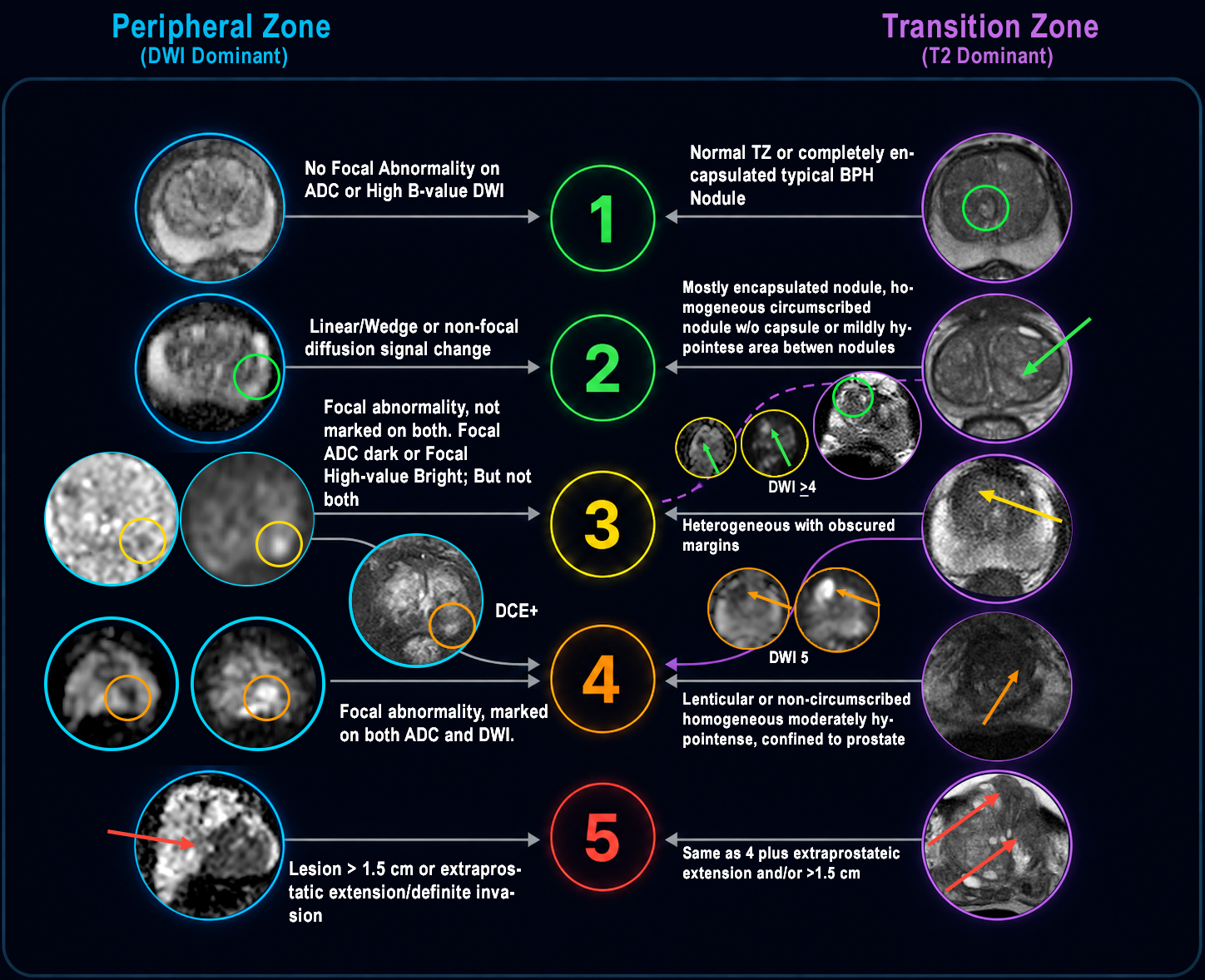 PI-RADS v2.1 visual tutorial with peripheral zone and transition zone MRI examples for PI-RADS scores 1 through 5