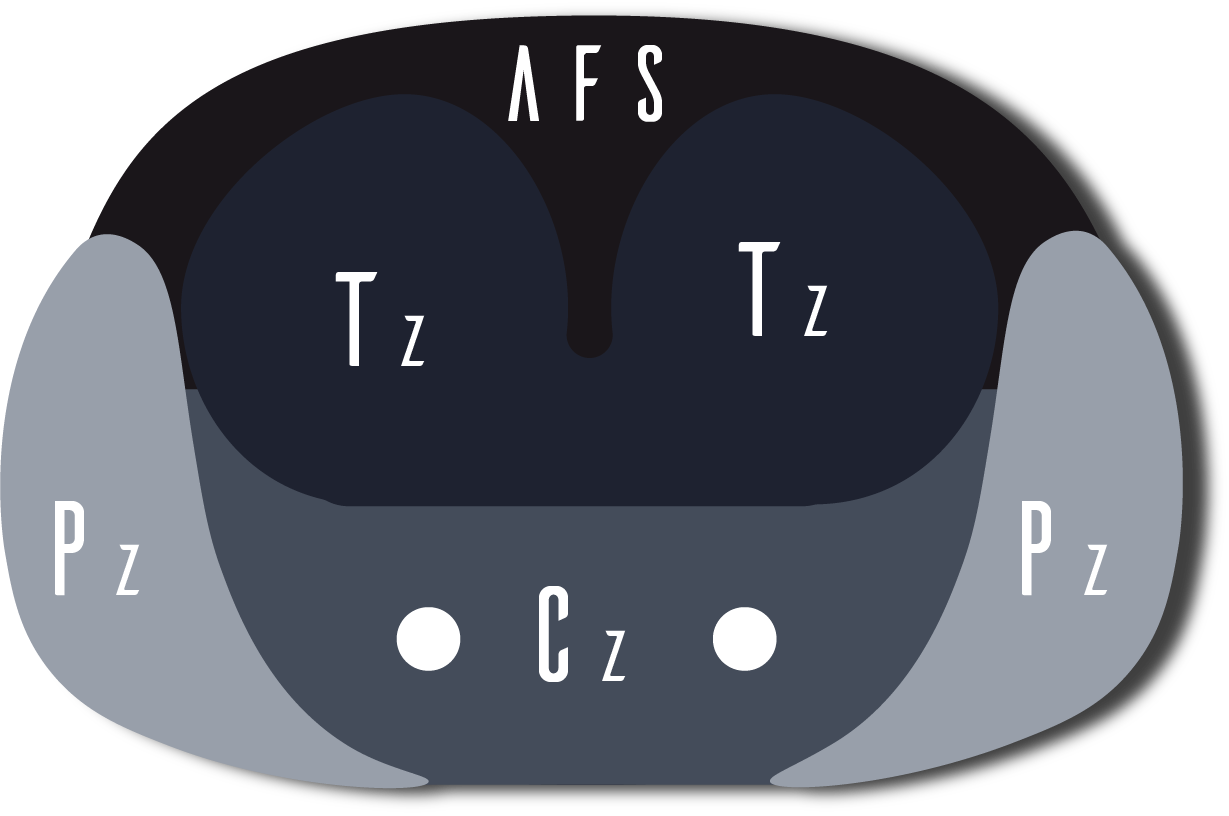 Schematic prostate zones labeled PZ, TZ, CZ, and AFS