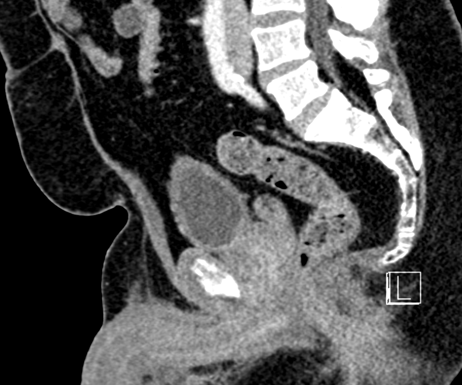 Sagittal pelvic CT showing limited soft-tissue differentiation around the prostate and adjacent structures