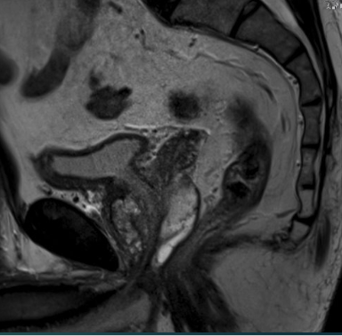 Sagittal T2-weighted MRI showing detailed zonal anatomy of the prostate and seminal vesicles