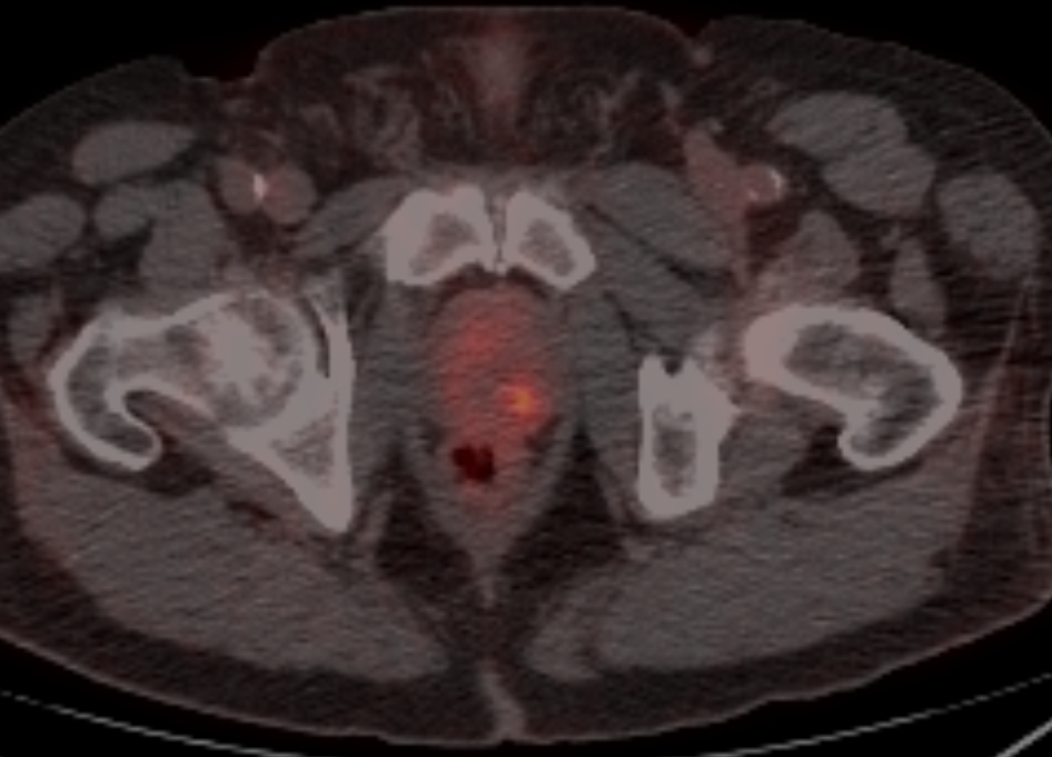 Axial PSMA PET/CT fusion image showing a focal region of increased tracer uptake in the prostate, the Gleason 3+3 focus
