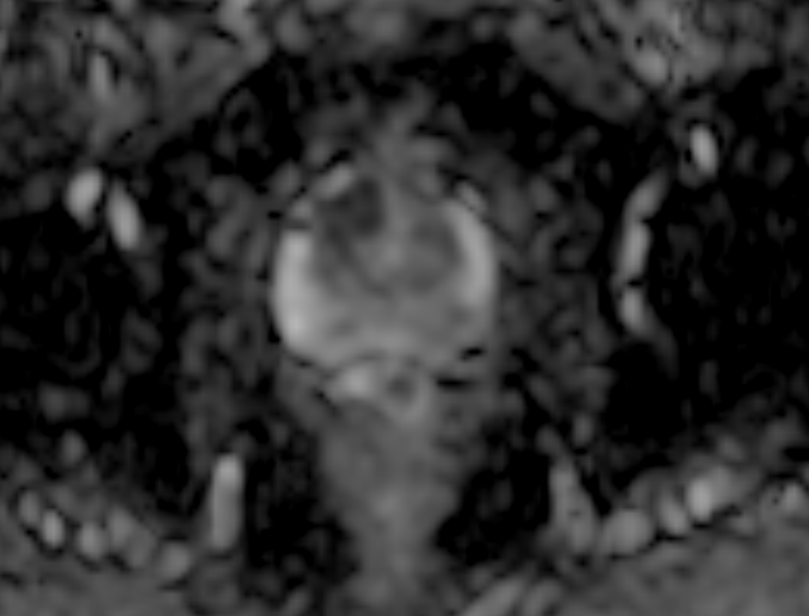 ADC map of the prostate corresponding to the Gleason 4+3 lesion