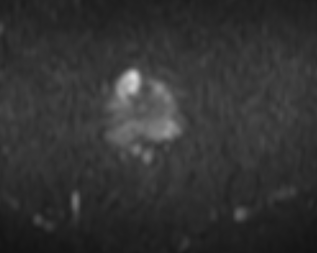 High b-value diffusion-weighted MRI showing a focal hyperintense lesion, the Gleason 4+3 focus