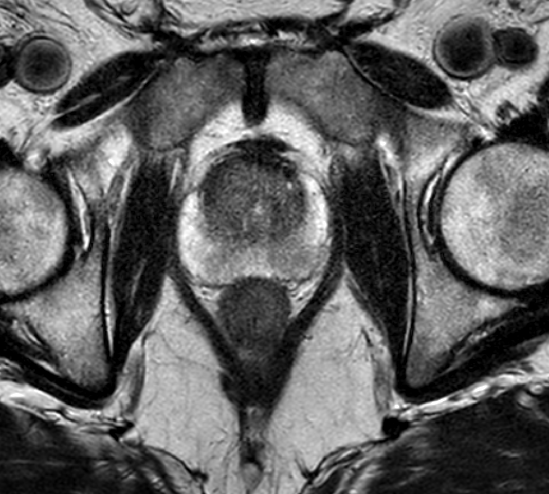 Axial T2-weighted MRI of the prostate corresponding to the Gleason 4+3 lesion
