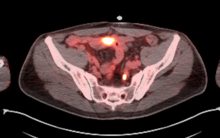 Axial PSMA PET/CT fusion image showing focal nodal uptake
