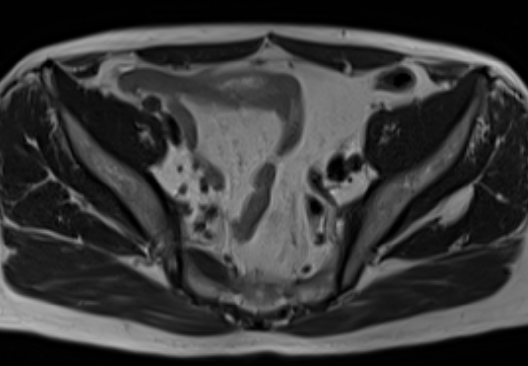 Axial T2-weighted pelvic MRI showing a morphologically subtle, normal-sized lymph node